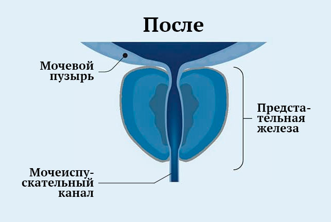 Уменьшение простаты и восстановление мочеиспускания после Rezūm